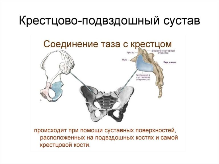 Сакроилеит крестцово подвздошного сочленения фото