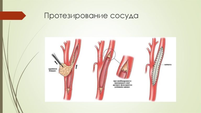 Подвздошная артерия рисунок