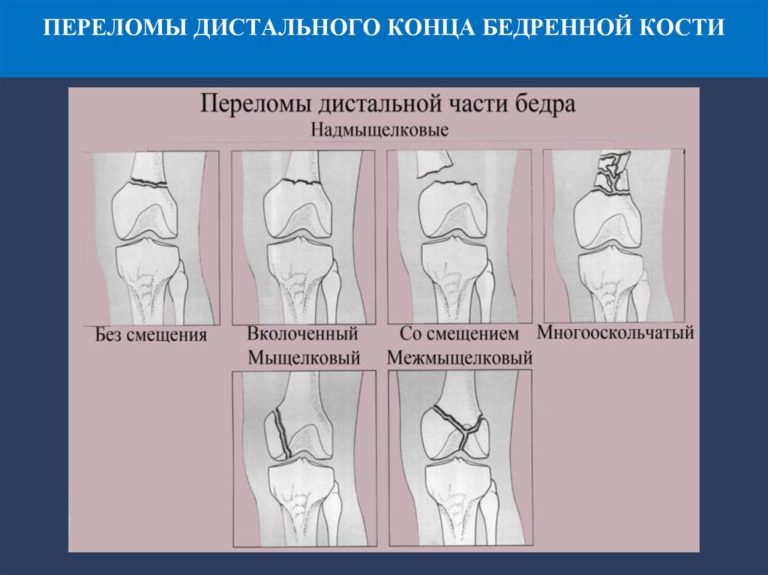 Перелом бедра карта вызова скорой помощи