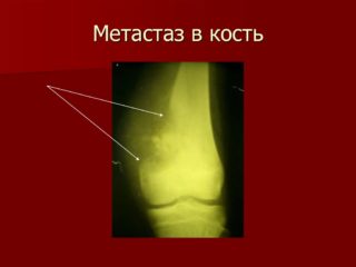 Перелом бедренной кости при метастазах
