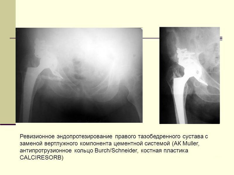 Вывих тазобедренного сустава после эндопротезирования фото