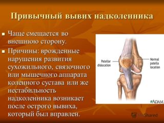 Как лечить привычный вывих коленного сустава