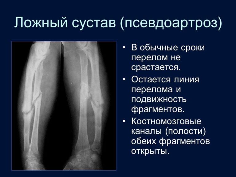 План сестринских вмешательств при переломе шейки бедра