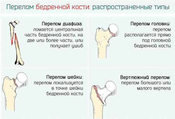 Карта вызова смп перелом бедра