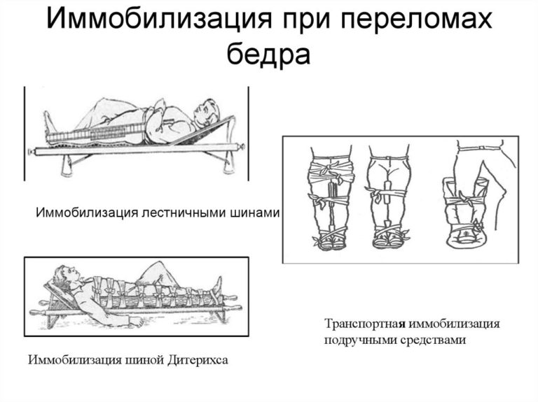 План сестринских вмешательств при переломе шейки бедра