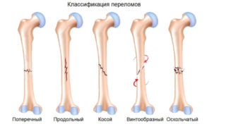 Переломы проксимального эпифиза бедренной кости