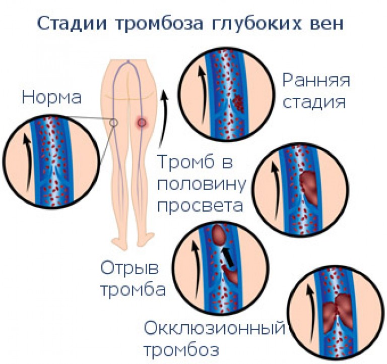 Как проверить есть ли в организме тромбы