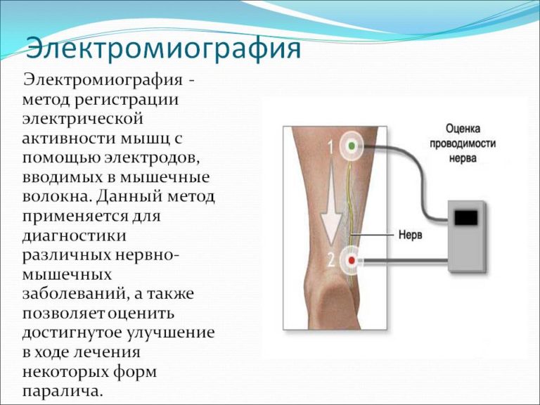 Дистрофия мышц фото