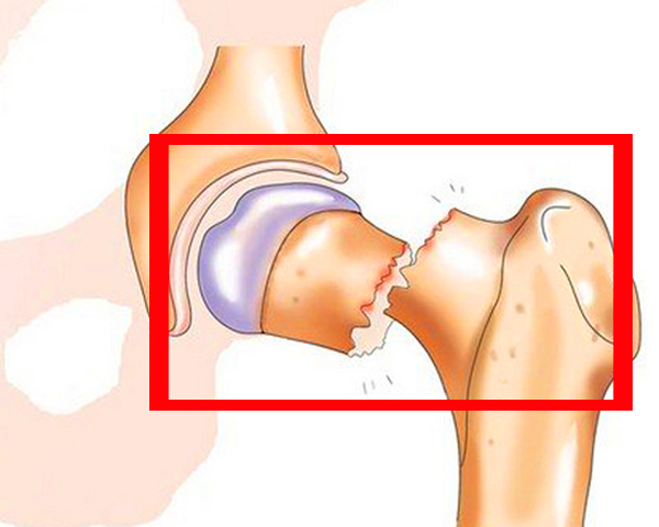 Шейка бедра картинка