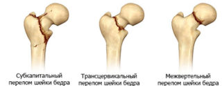 Фиксация костей при переломе бедра