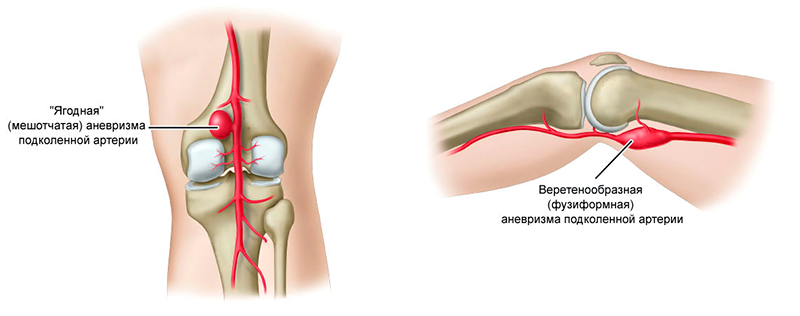 Болит под коленкой. Болит колено внутри сбоку с внутренней стороны. Ноет колено внутри сбоку. Аневризм подколенной артерии. Болит косточка сбоку колена с внутренней стороны.