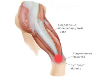 Изображение - Болят связки коленного сустава после бега Iliotibial-Band-Syndrome1-320x266
