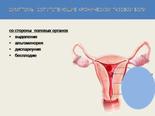 Миофасциальный синдром тазового дна у женщин