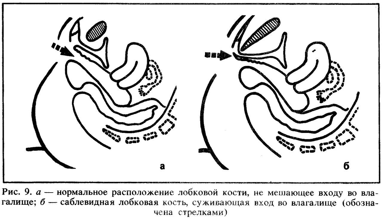 Саблевидная лобковая кость