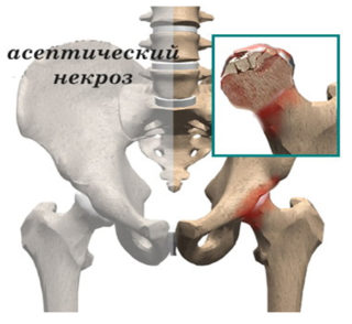 Субкапитальный перелом шейки левой бедренной кости thumbnail