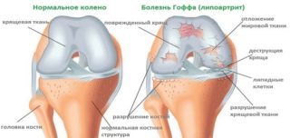Болит на сгибе колена с внутренней стороны