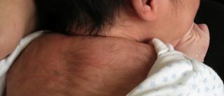 Волосы на копчике у новорожденных