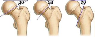 Субкапитальный перелом шейки правой бедренной кости