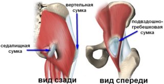 Болезнь бьюкенена остеохондропатия гребня подвздошной кости