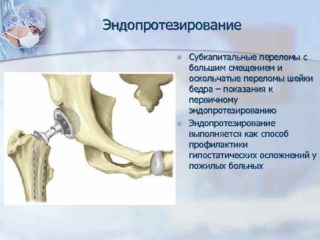 Субкапитальный перелом шейки левой бедренной кости