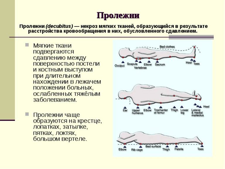 Пролежни на крестце фото