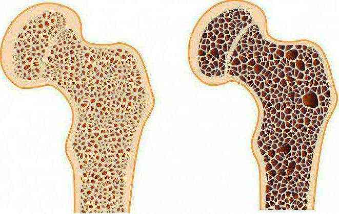 Остеопороз тазобедренного сустава – лечение и профилактика
