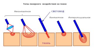 Изображение - Электрофорез при коксартрозе тазобедренного сустава lazernaja-blefaroplastika_03-320x166