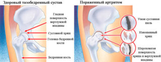 Комплексное лечение артрита тазобедренного сустава