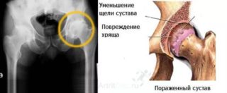 Народные средства для лечения остеохондроза тазобедренного сустава thumbnail