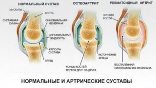 Болит мышца с обратной стороны колена
