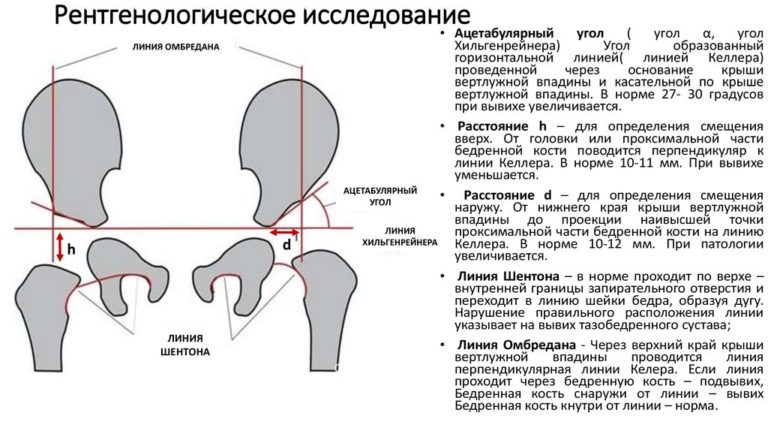 Коксартроз тазобедренного сустава фото