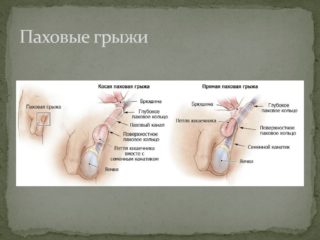 Отек области лобковой кости