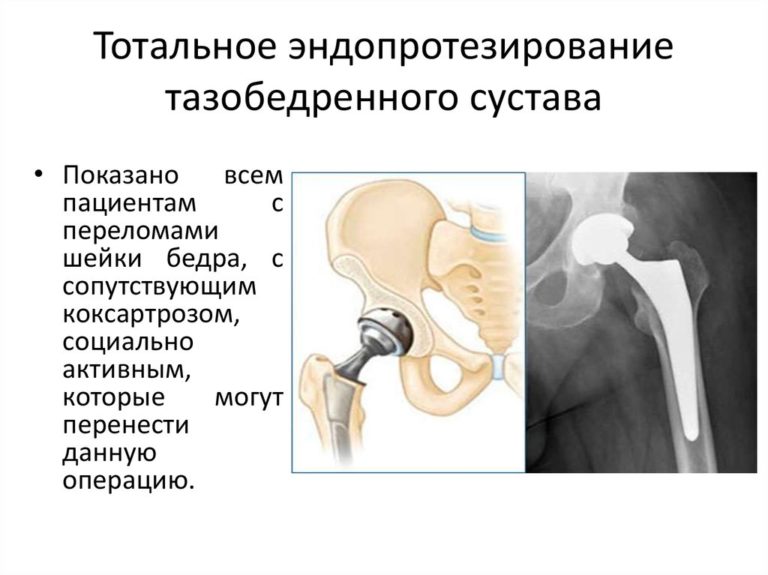 Коксартроз 3 степени фото