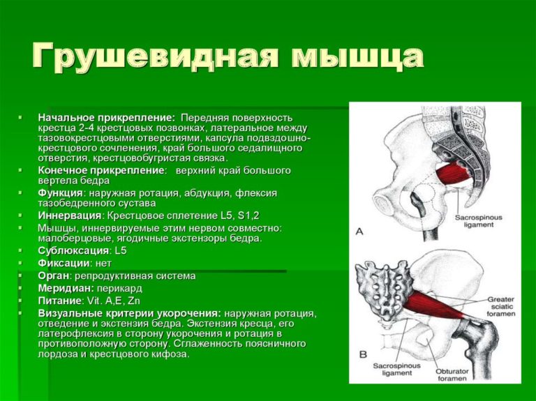 Синдром грушевидной мышцы фото