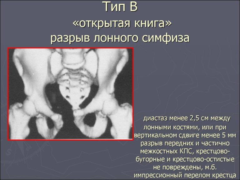 Лобковая кость у женщин при беременности где находится фото