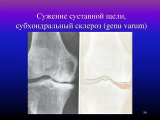 Склероз тазобедренных суставов лечение thumbnail