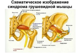 Синдром грушевидной мышцы лечение блокада