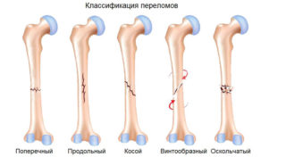 При переломе бедренной кости фиксируют суставы