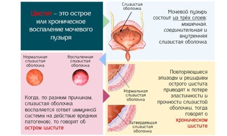 Где находится мочевыводящий канал у женщин фото