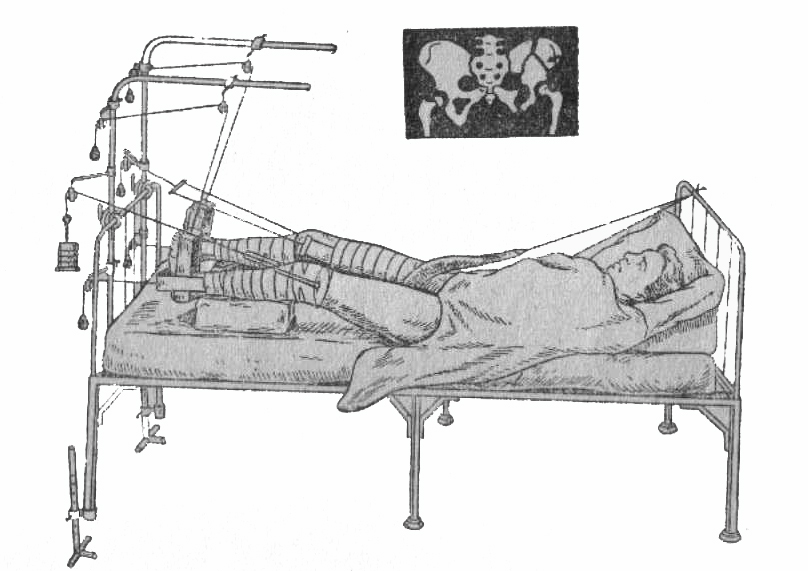 Лечение переломов костей. Перелом таза скелетное вытяжение. Скелетное вытяжение костей таза. Вытяжение при переломах костей таза. Вытяжение при переломе таза.
