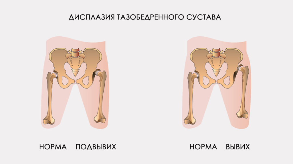 Артралгия тазобедренного сустава у детей. Дисплазия тазобедренных суставов причины, симптомы и лечение дисплазии. Дисплазия тазобедренных суставов у ребенка: полное описание, симптомы и. Как сделать тазовую кость уже