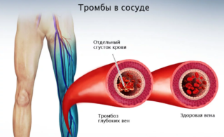 Болезни кровеносных сосудов малого таза