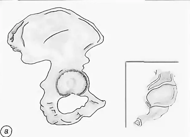 Что значит вертлужная впадина. Анатомия вертлужной впадины тазобедренного сустава. Крыша вертлужной впадины анатомия. Классификация переломов вертлужной впадины по Летурнелю.
