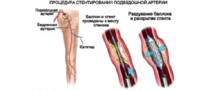 Атеросклероз подвздошных артерий симптомы