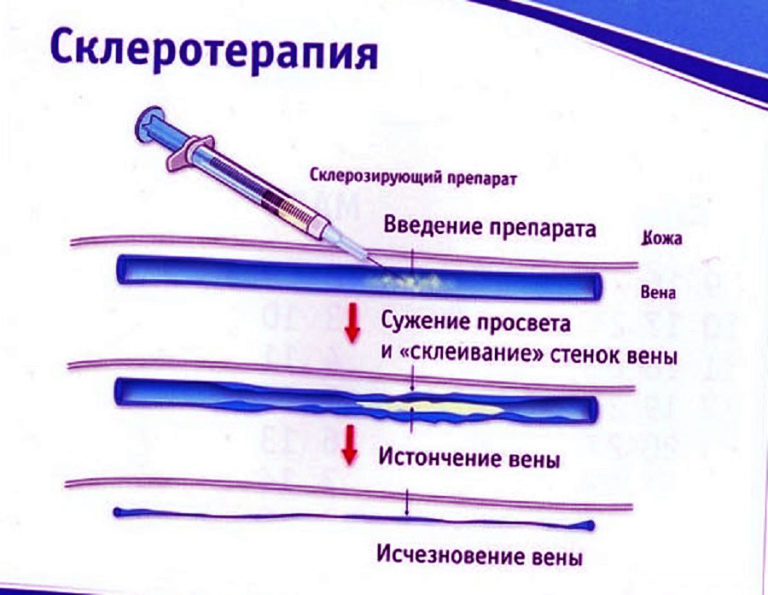 Лечение варикоза малого таза у женщин препараты схема лечения