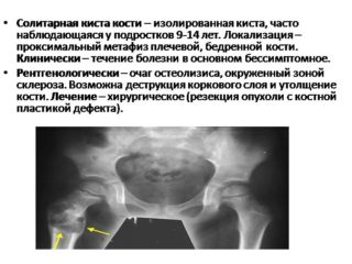 Киста головки тазобедренного сустава лечение последствия