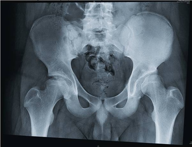 Как делают рентген тазобедренного сустава фото взрослых