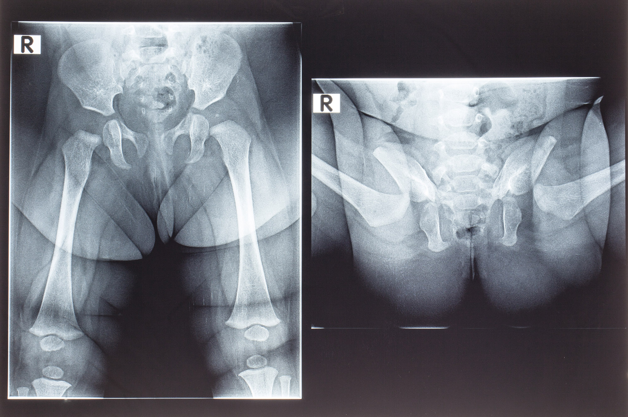 Рентген тазобедренных суставов у детей. Норма