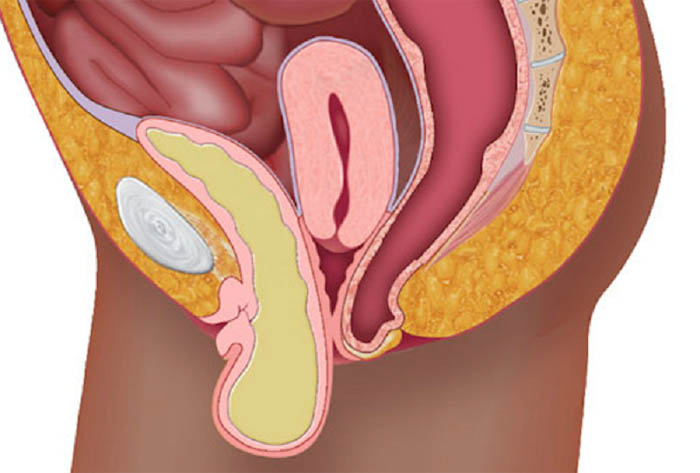 Фото выпадение мочевого пузыря у женщин