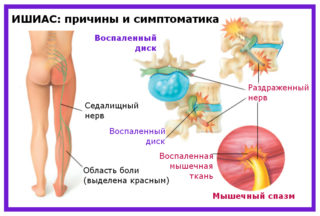 Остеохондроз позвоночника седалищный нерв